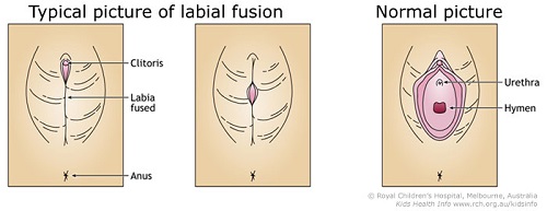 Labial fusion